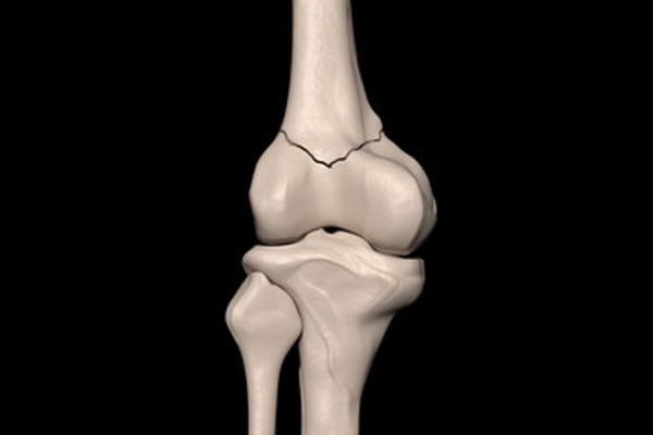 fracture de femur fracture femur reeducation fracture femur convalescence docteur anthony wajsfisz chirurgien du genou paris