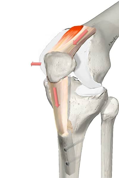 abaissement tta genou abaissement de la tta tuberosite tibiale anterieure douleur tuberosite tibiale anterieure tuberosite tibiale posterieure dr wajsfisz chirurgien specialiste du genou a paris