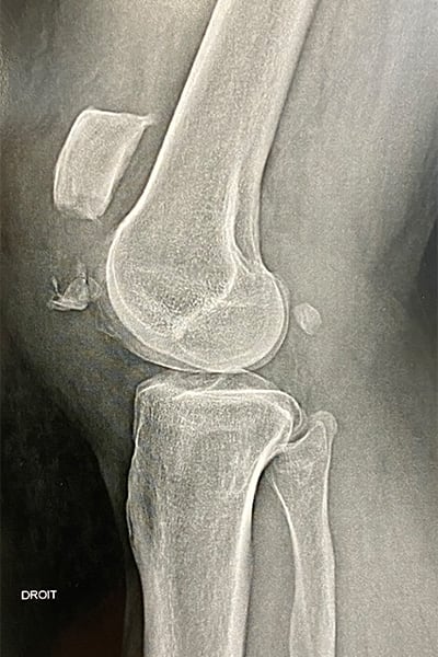 anatomie tendon rotulien rupture tendon rotulien fissure tendon rotulien dechirure docteur anthony wajsfisz chirurgien orthopediste specialiste du genou a paris
