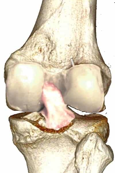 arrachement de la surface retrospinale du tibia ligament croise posterieur anatomie docteur anthony wajsfisz chirurgien orthopediste specialiste du genou a paris