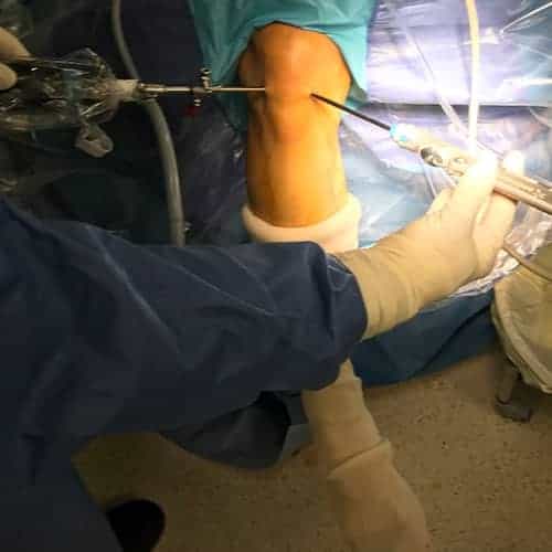 arthroscopie genou menisque arthroscopie genou douleur postoperatoire genou apres arthroscopie docteur anthony wajsfisz chirurgien orthopediste specialiste du genou a paris