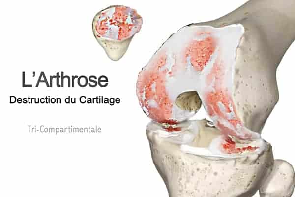 arthrose genou symptomes arthrose genou que faire gonarthrose tricompartimentale gonarthrose def gonarthrose du genou dr wajsfisz chirurgien orthopediste specialiste du genou a paris