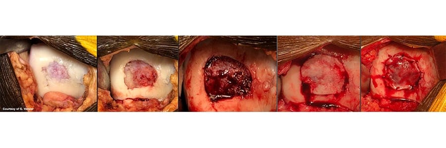 chondro gide membrane stimulation de la moelle osseuse docteur anthony wajsfisz chirurgien orthopediste specialiste du genou a paris