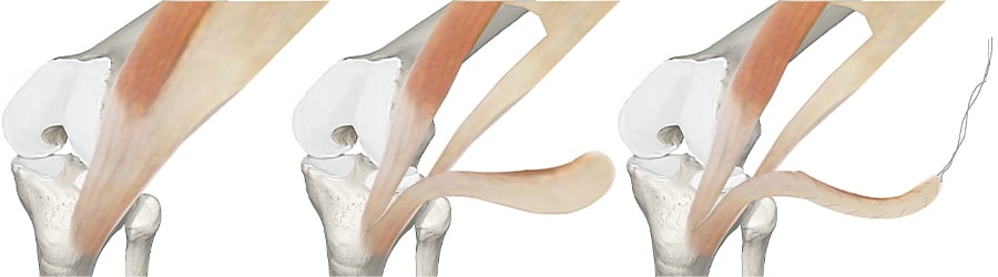 fascia lata genou fascia lata tendon fascia lata anatomie docteur anthony wajsfisz chirurgien orthopediste specialiste du genou a paris