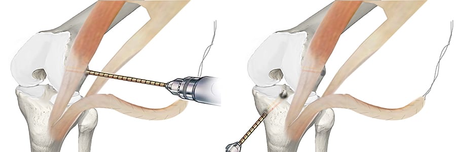 fascia lata genou femoral tunnel position in acl reconstruction docteur anthony wajsfisz chirurgien orthopediste specialiste du genou a paris