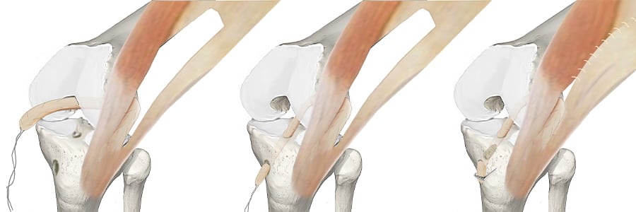fascia lata lca operation ligament croise anterieur rupture des ligaments croises docteur anthony wajsfisz chirurgien orthopediste specialiste du genou a paris