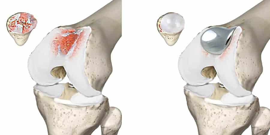 forum prothese femoro patellaire zimmer prothese rotule uniquement prothese rotule genoux prothese rotulienne docteur anthony wajsfisz chirurgien orthopediste specialiste du genou a paris