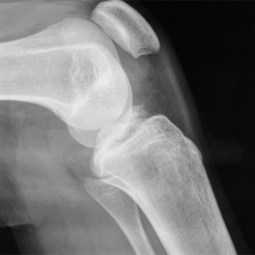 fracture arrachement epines tibiales definition arrachement osseux de l insertion tibiale du LCA docteur anthony wajsfisz chirurgien orthopediste specialiste du genou a paris