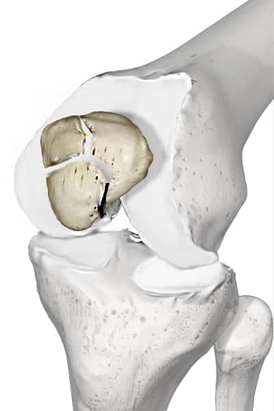 fracture comminutive definition fracture rotule genoux rotule genou deplacee fracture de la rotule deplacee docteur anthony wajsfisz chirurgien orthopediste specialiste du genou a paris