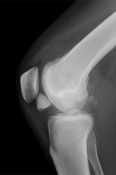 fracture communitive du condyle femoral avec extrusion articulaire de fragments extrusion medecine docteur anthony wajsfisz chirurgien orthopediste specialiste du genou a paris