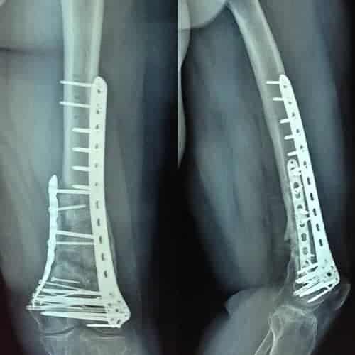 fracture complexe definition fracture complexe femur docteur anthony wajsfisz chirurgien orthopediste specialiste du genou a paris