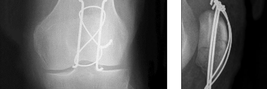 fracture de la rotule temps de guerison fracture rotule traitement fracture rotule consolidation docteur anthony wajsfisz chirurgien orthopediste specialiste du genou a paris