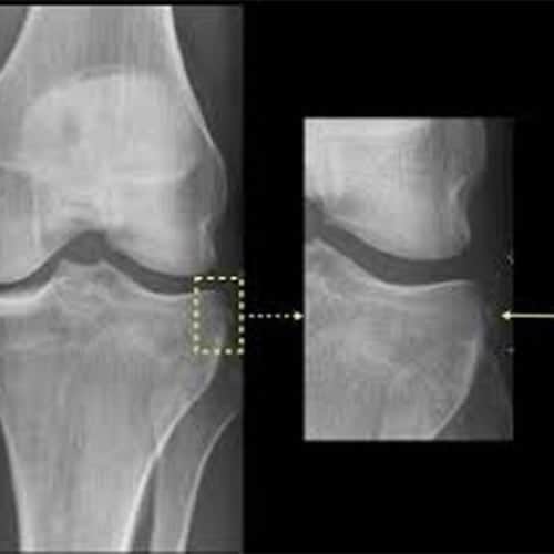 fracture de segond traitement fracture de segond avulsion osseuse antero-externe des fibres antero-laterales pathognomonique rupture du LCA dr wajsfisz chirurgien specialiste du genou a paris