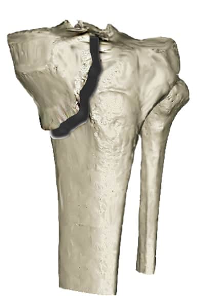 fracture plateau tibial douleur plateau tibial externe contusion osseuse plateau tibial traitement docteur anthony wajsfisz chirurgien orthopediste specialiste du genou a paris