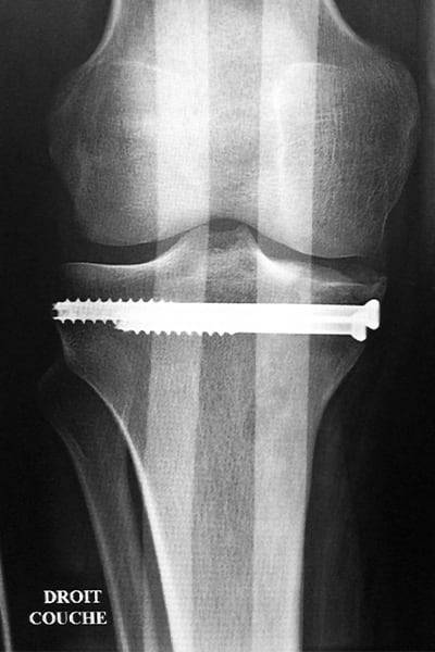 fracture plateau tibial sequelles classification fracture plateau tibial fracture plateau tibial sans deplacement docteur anthony wajsfisz chirurgien orthopediste specialiste du genou a paris