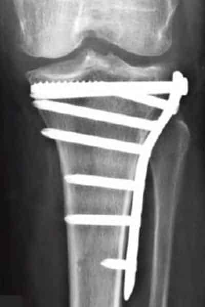 fracture plateau tibial temps de guerison plateau tibial casse tibial plateau fracture radiology docteur anthony wajsfisz chirurgien orthopediste specialiste du genou a paris