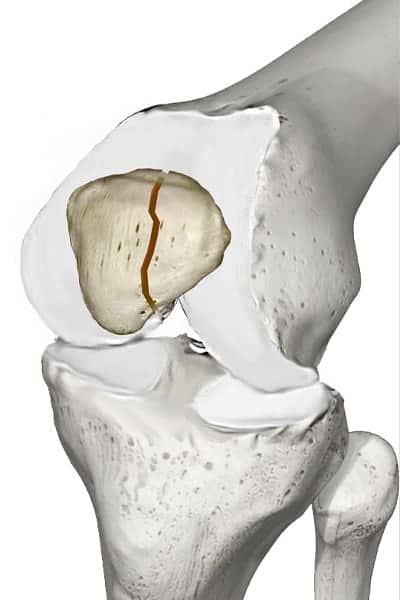 fracture rotule genoux fracture de la rotule sequelles fracture de rotule