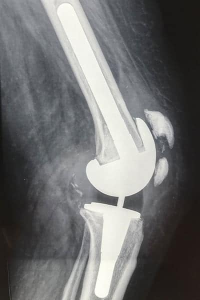 fracture rotule genoux fracture de la rotule sequelles prothese genoux avis prothese de genou totale ou unicompartimentale dr wajsfisz chirurgien orthopediste specialiste du genou a paris