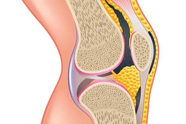 traitement synovite genou traitement synovite villonodulaire genou irm docteur anthony wajsfisz chirurgien du genou paris