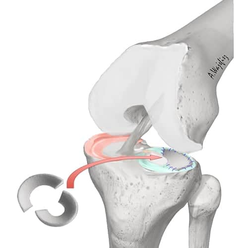 implant menisque implant meniscal implant genou docteur anthony wajsfisz chirurgien orthopediste specialiste du genou a paris