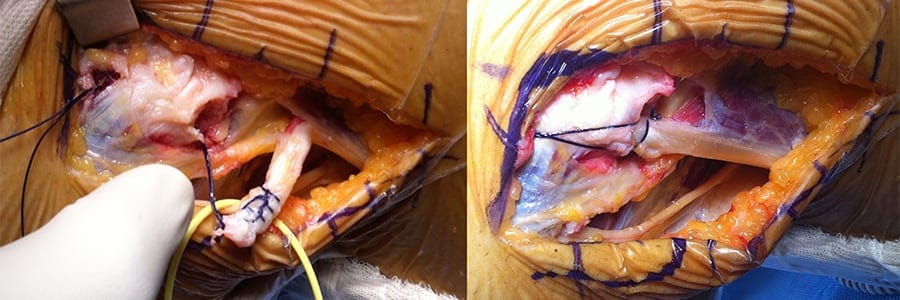 insertion of biceps femoris tendon docteur anthony wajsfisz chirurgien orthopediste specialiste du genou a paris