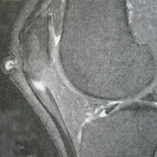 irm rotule genou tendinopathie du tendon rotulien tendinopathie rotulienne docteur anthony wajsfisz chirurgien orthopediste specialiste du genou a paris