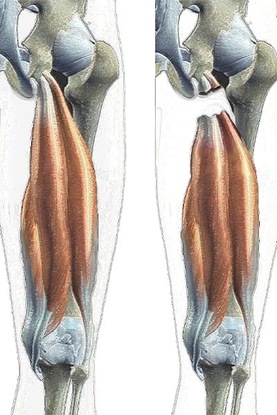 ischio jambier anatomie ischio jambier dechirure ischio jambier blessure docteur anthony wajsfisz chirurgien orthopediste specialiste du genou a paris