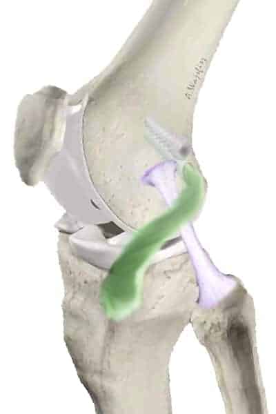 lca plastie de lemaire tenodese laterale genou chirurgie des ligaments croises anterieurs docteur anthony wajsfisz chirurgien orthopediste specialiste du genou a paris