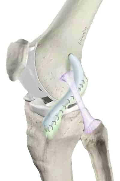 lca plastie de lemaire tenodese laterale genou docteur anthony wajsfisz chirurgien orthopediste specialiste du genou a paris