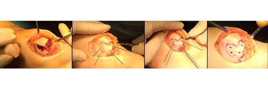 lesion osteochondrale genou lesion osteochondrale patellaire osteochondrite genoux docteur anthony wajsfisz chirurgien orthopediste specialiste du genou a paris