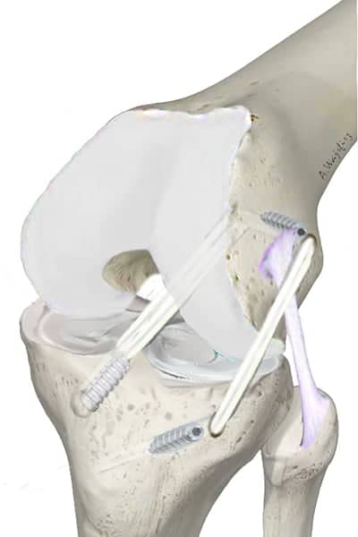ligament antero lateral du genou ligament antero-lateral genou docteur anthony wajsfisz chirurgien orthopediste specialiste du genou a paris