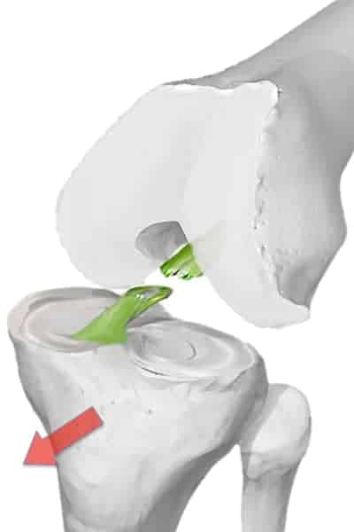 ligament croise anterieur du genou ligament croise anterieur rupture tiroir anterieur genou dr wajsfisz chirurgien orthopediste specialiste du genou a paris