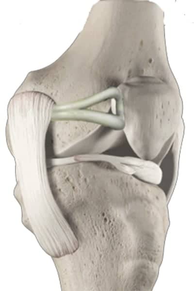 ligamentoplastie du genou ligamentoplastie mpfl operation ligamentoplastie genou reeducation ligamentoplastie genou technique dr wajsfisz chirurgien orthopediste specialiste du genou a paris