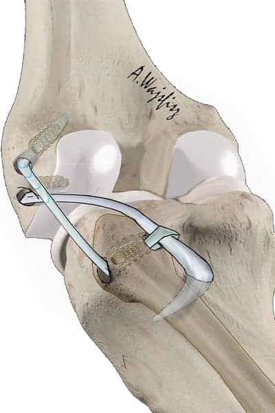 ligamentoplastie plastie ligament croise anterieur plastie ligamentaire du genou docteur anthony wajsfisz chirurgien orthopediste specialiste du genou a paris