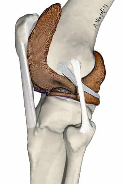 liquide synoviale genou synovie genou articulation synoviale exemple docteur anthony wajsfisz chirurgien orthopediste specialiste du genou a paris
