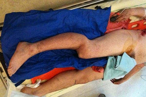 luxation du genou arret de travail luxation genou symptomes que faire docteur anthony wajsfisz chirurgien orthopediste specialiste du genou a paris