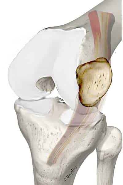 luxation rotule genou luxation rotule exercices luxation rotule traitement docteur anthony wajsfisz chirurgien orthopediste specialiste du genou a paris