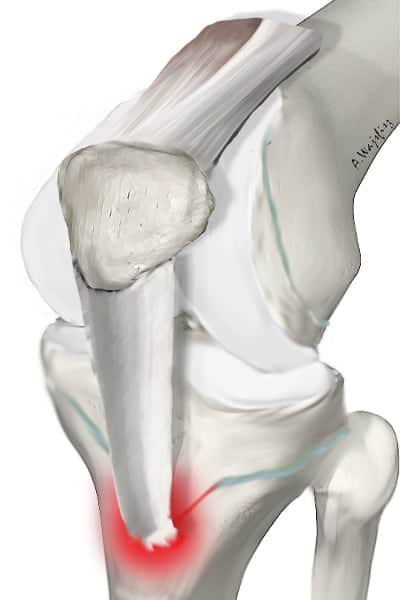 maladie d osgood schlatter adulte syndrome d osgood schlatter genou osgood schlatter operation docteur anthony wajsfisz chirurgien orthopediste specialiste du genou a paris