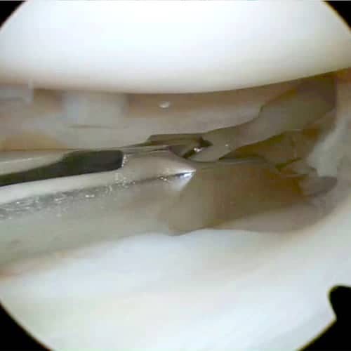 meniscectomie totale meniscectomie sous arthroscopie genou meniscectomie definition docteur anthony wajsfisz chirurgien orthopediste specialiste du genou a paris