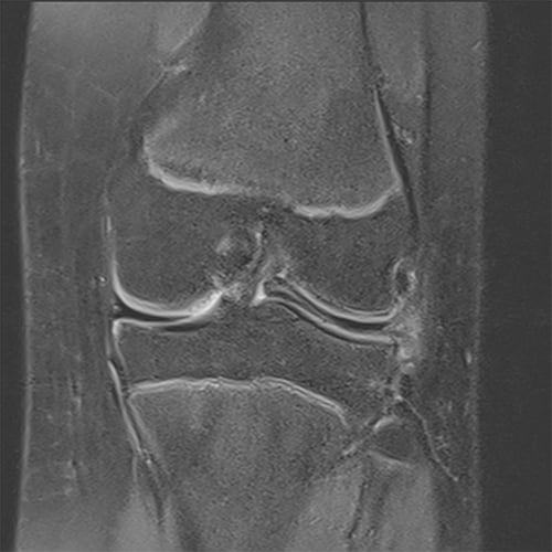 menisque discoide irm menisque discoide symptome vivre avec une fissure du menisque docteur anthony wajsfisz chirurgien orthopediste specialiste du genou a paris
