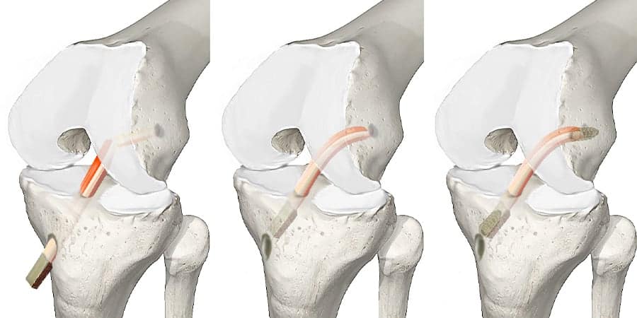 montee du transplant os tendon a travers les tunnels tibial et femoral docteur anthony wajsfisz chirurgien orthopediste specialiste du genou a paris