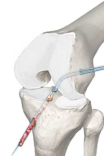 nouveau ligament genou ligament du genou didt dt4 docteur anthony wajsfisz chirurgien orthopediste specialiste du genou a paris