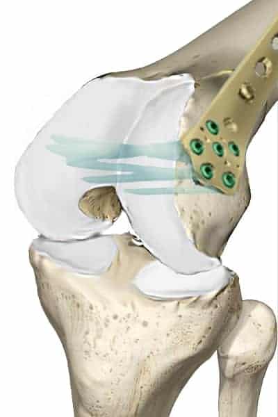 osteosynthese femur osteosynthese femorale osteosynthese par plaque vissee osteosynthese avec plaque avantages et inconvenients dr wajsfisz chirurgien orthopediste genou a paris