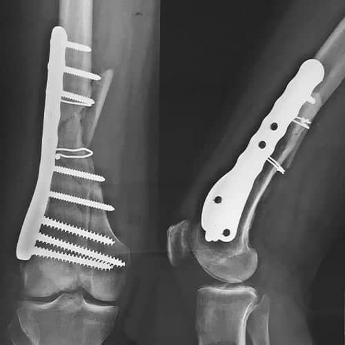 osteosynthese par plaque vissee osteosynthese avec plaque avantages et inconvenients osteosynthese femur osteosynthese femorale dr wajsfisz chirurgien orthopediste specialiste du genou a paris