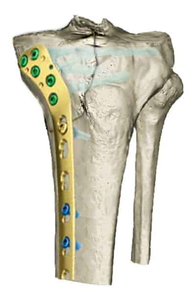 osteosynthese tibia ablation materiel osteosynthese tibia fracture tibia osteosynthese docteur anthony wajsfisz chirurgien orthopediste specialiste du genou a paris