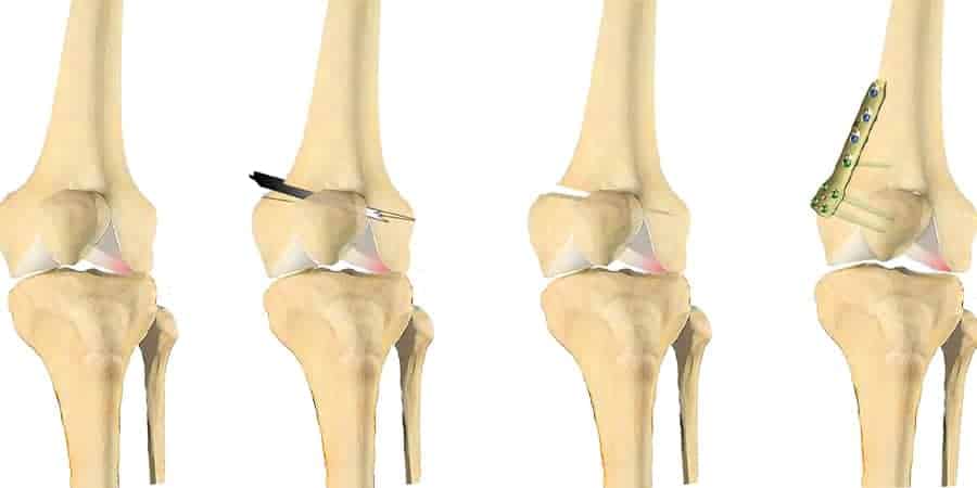 osteotomie de varisation genou osteotomie de varisation femorale osteotomie femorale de varisation genou docteur anthony wajsfisz chirurgien orthopediste specialiste du genou a paris