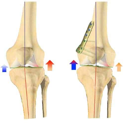 osteotomie femorale de varisation osteotomy of femur osteotomie femorale de valgisation docteur anthony wajsfisz chirurgien orthopediste specialiste du genou a paris