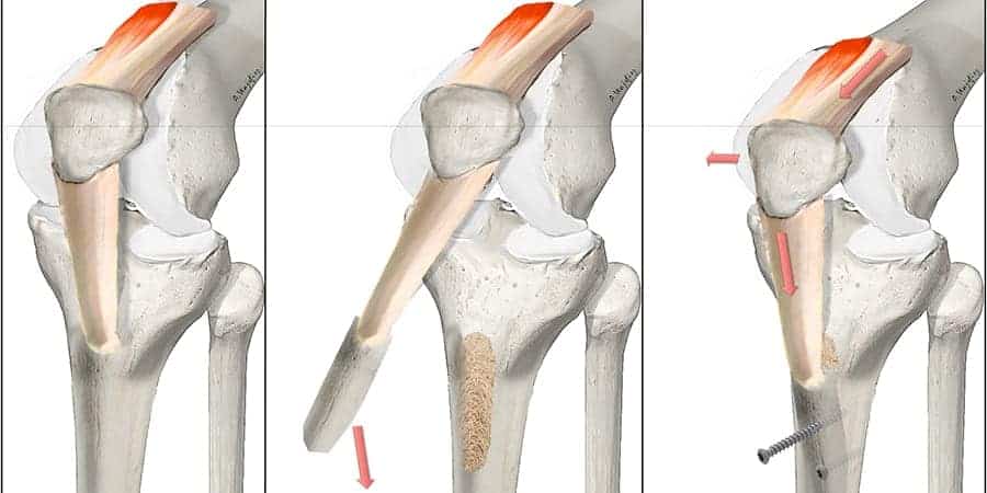 osteotomie tta genou douleur osteotomie du genoux docteur anthony wajsfisz chirurgien orthopediste specialiste du genou a paris