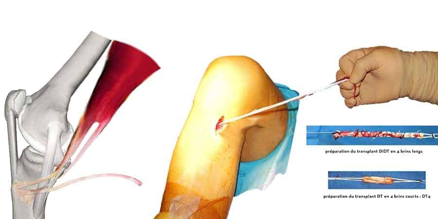 prelevement tendon didt dt4 genou ligamentoplastie dt4 reeducation docteur anthony wajsfisz chirurgien orthopediste specialiste du genou a paris
