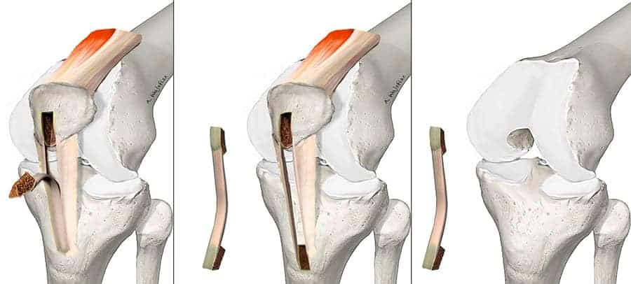 prelevement tendon rotulien operation kenneth jones cicatrice kenneth jones ou didt kj genou kj lca tendon rotulien docteur anthony wajsfisz chirurgien orthopediste specialiste du genou a paris